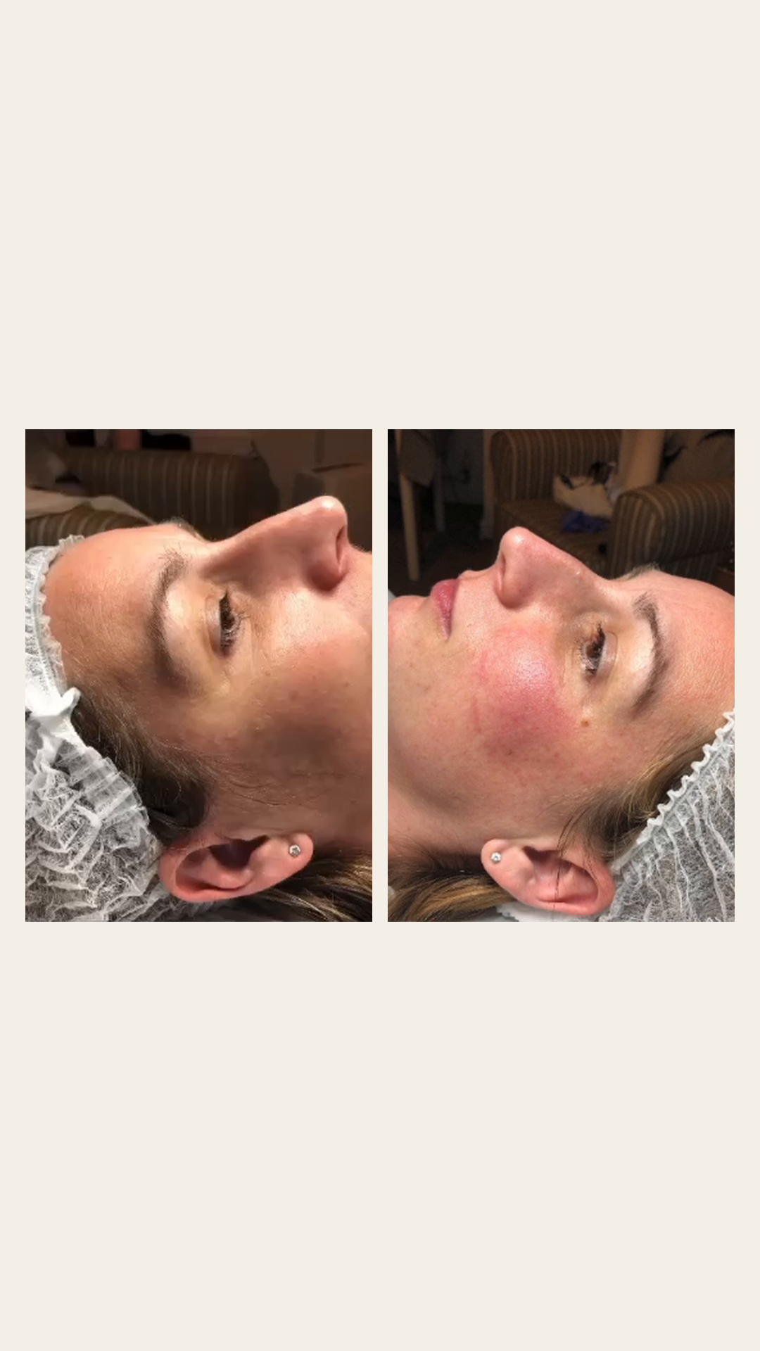 Before & After — Dermaplaning