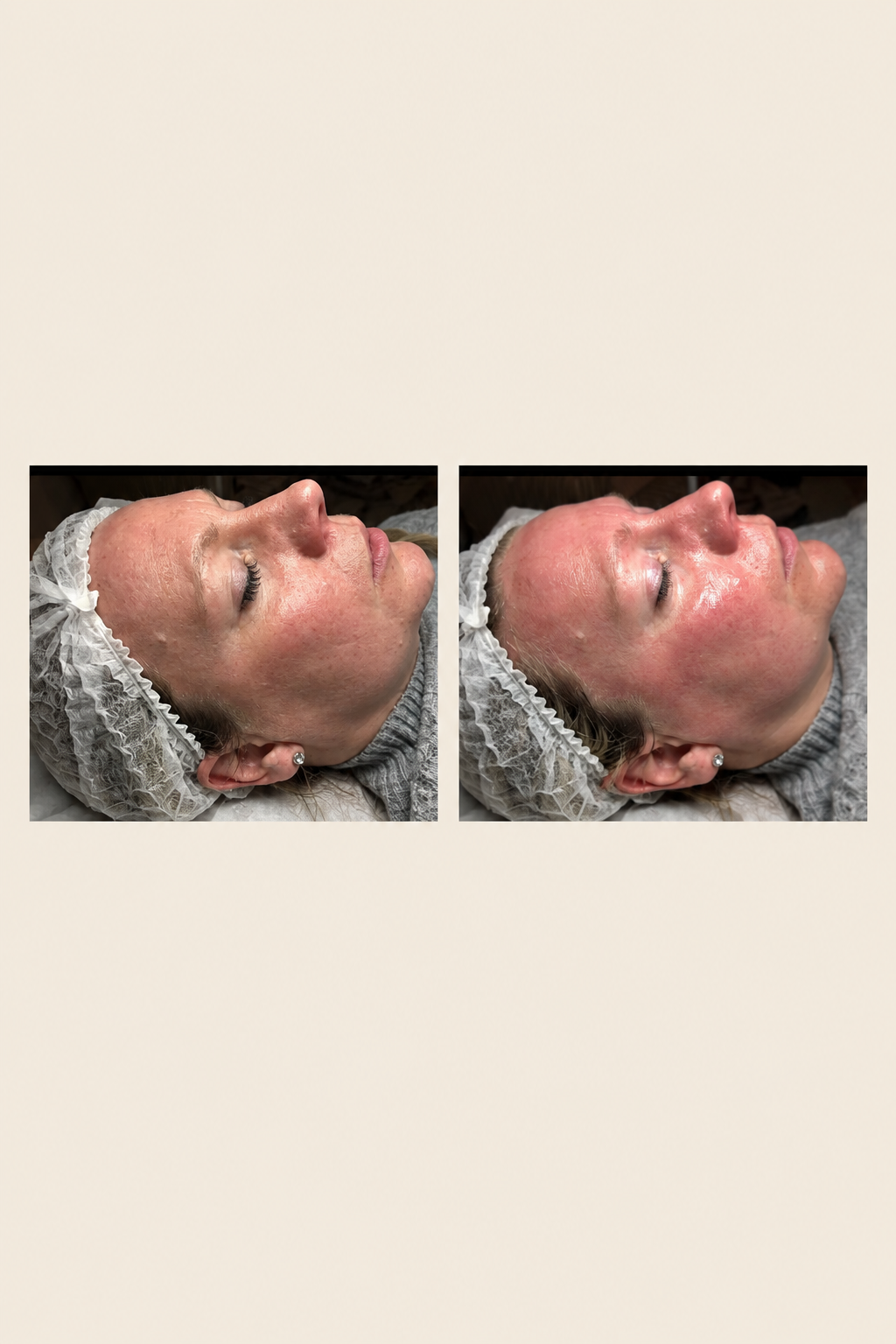 Before & After — Microneedling & Dermaplaning